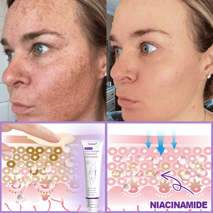💎Vitalisys® PDRN Multi-Peptide Massaging Body Roller Cream- Anti-aging, Hydrating, Skin Firming & Lifting, Skin Repair, Even Tone, Acne and Dark Spot Treatment, Wart and Mole Removal, and Psoriasis Relief.