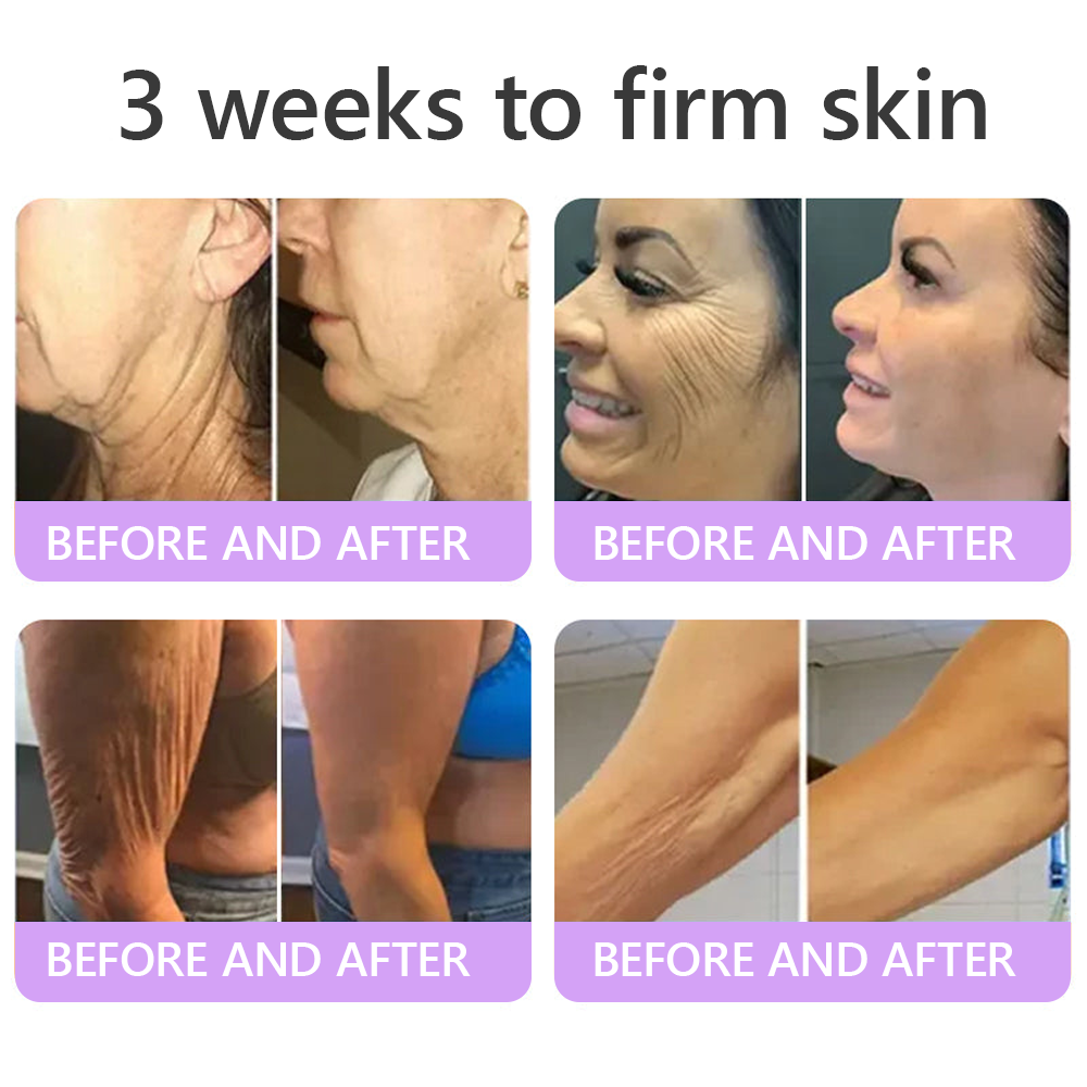 💎Vitalisys® PDRN Multi-Peptide Massaging Body Roller Cream- Anti-aging, Hydrating, Skin Firming & Lifting, Skin Repair, Even Tone, Acne and Dark Spot Treatment, Wart and Mole Removal, and Psoriasis Relief.